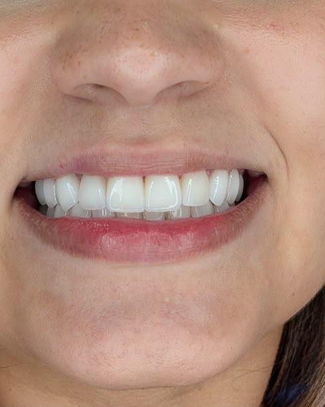SmileZone patient smile result